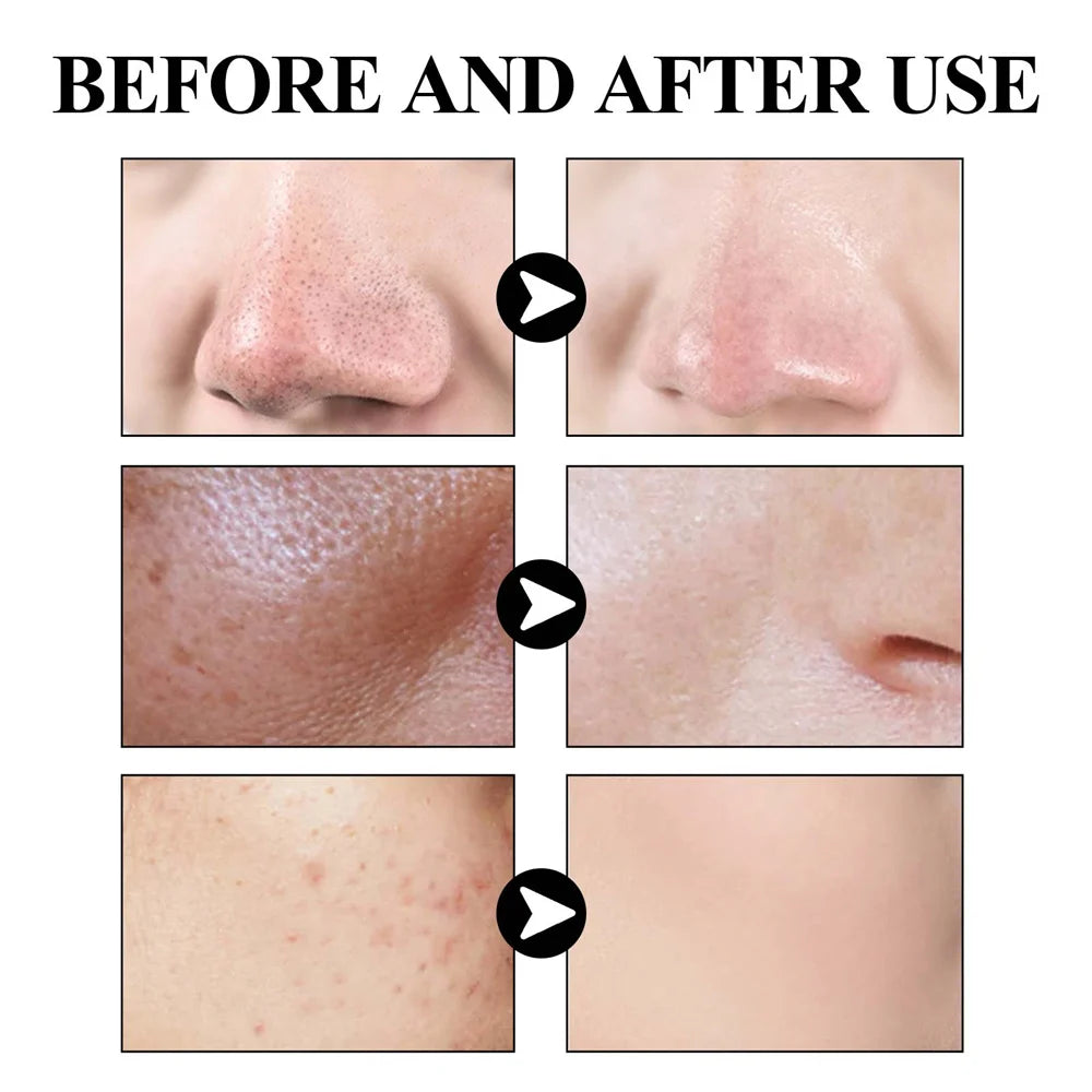 West & Month Blackhead Removing Mud Mask