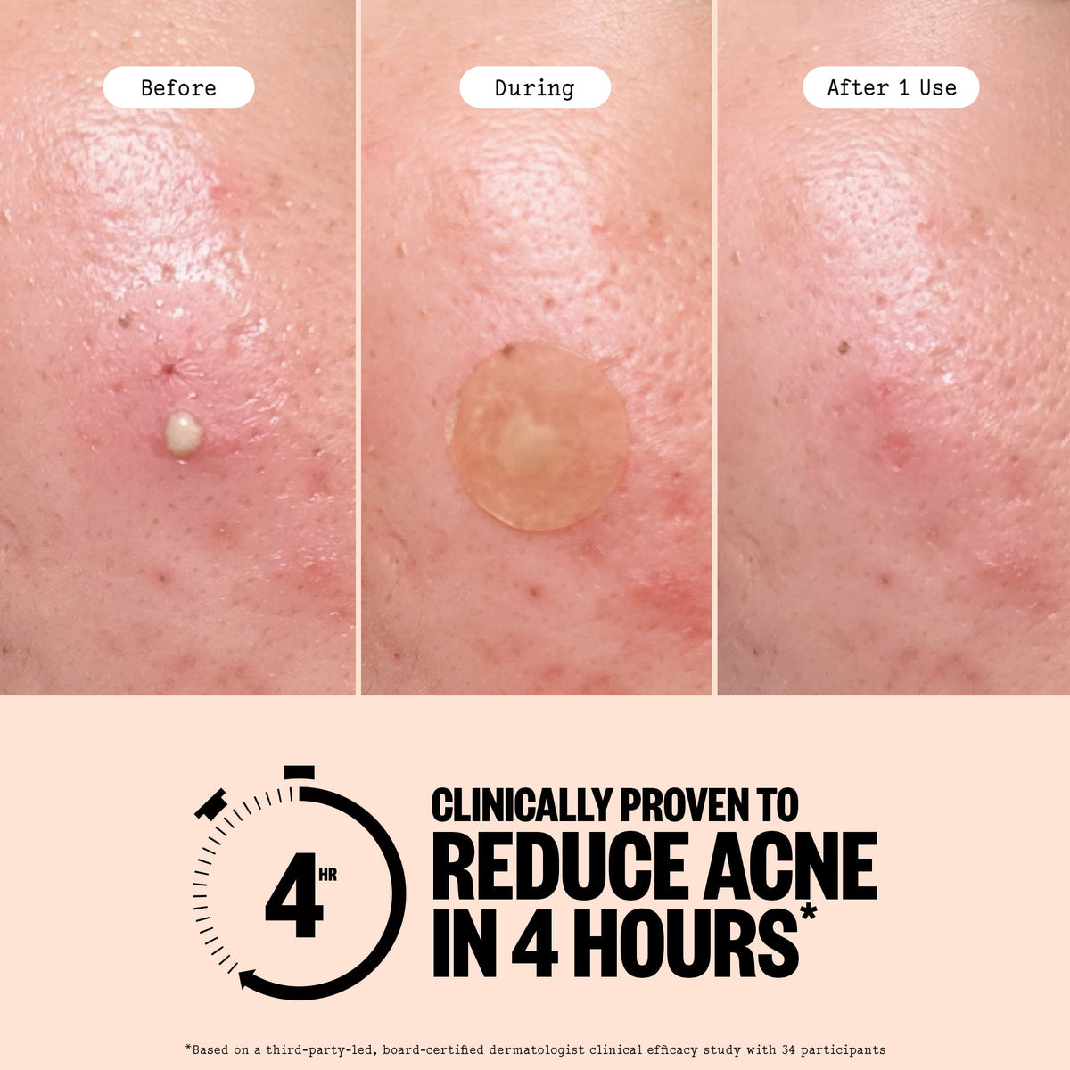 Acne Treatment Dots